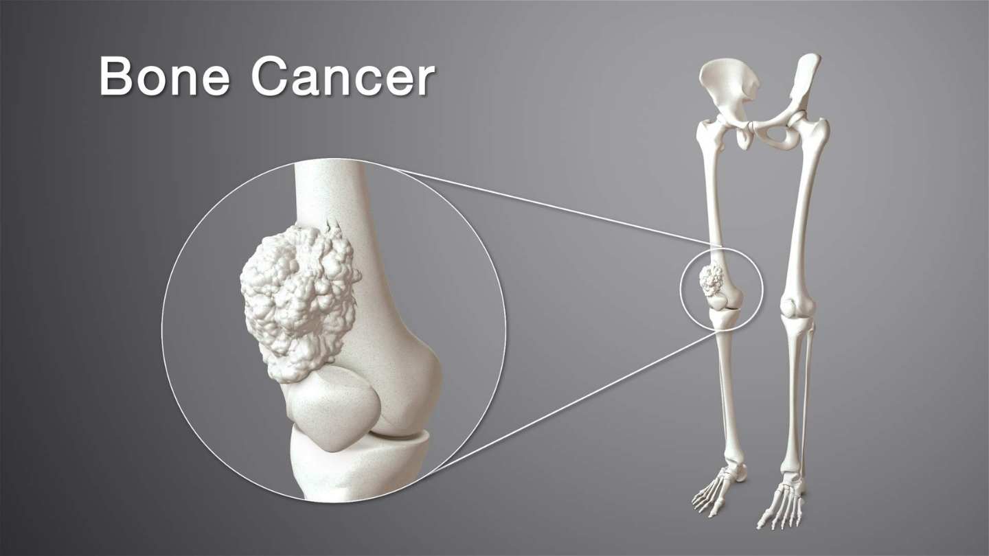 Bone Cancer Treatment in Kolkata